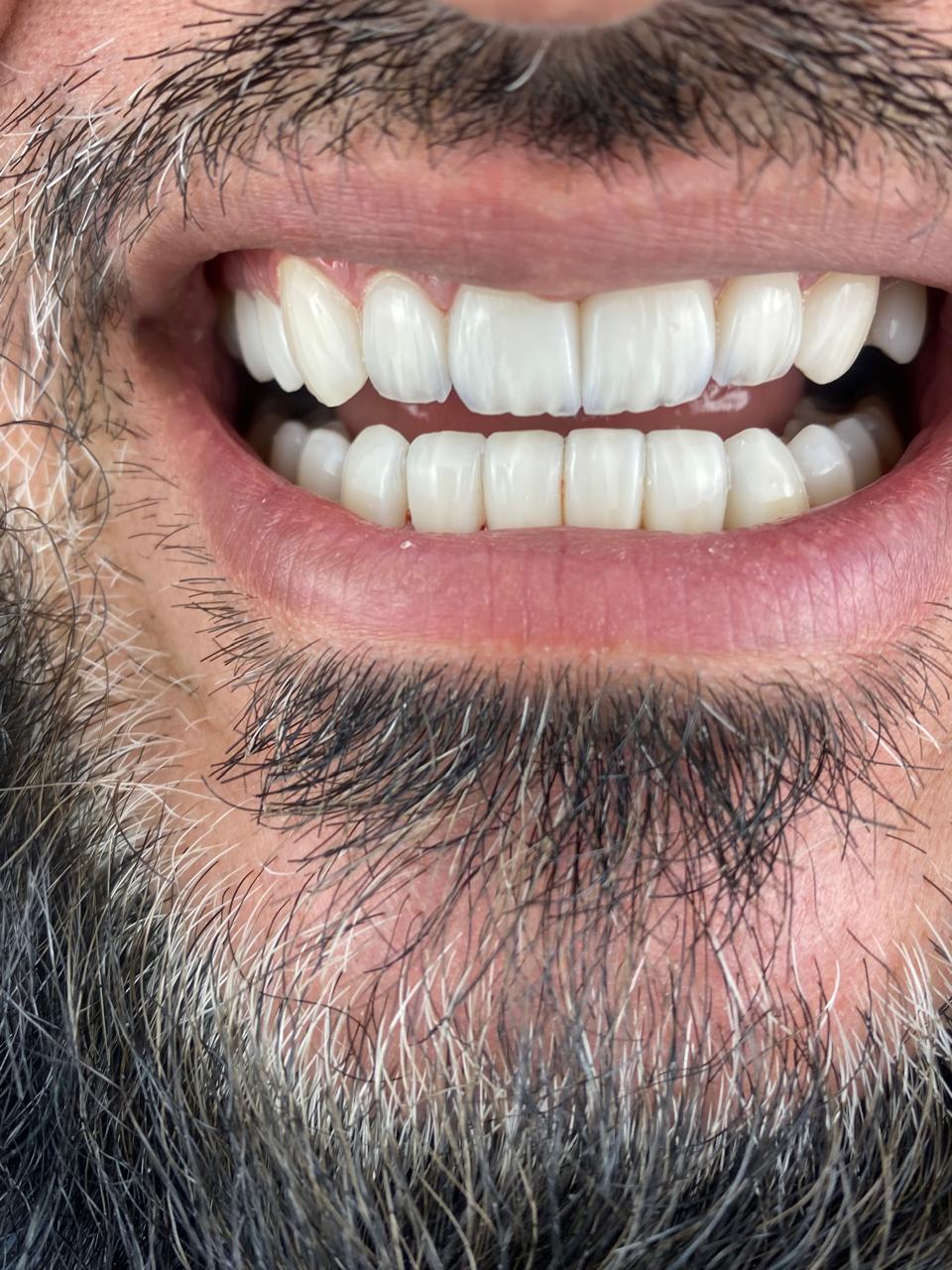 نتيجة علاج — تركيبات أسنان — حالة ١